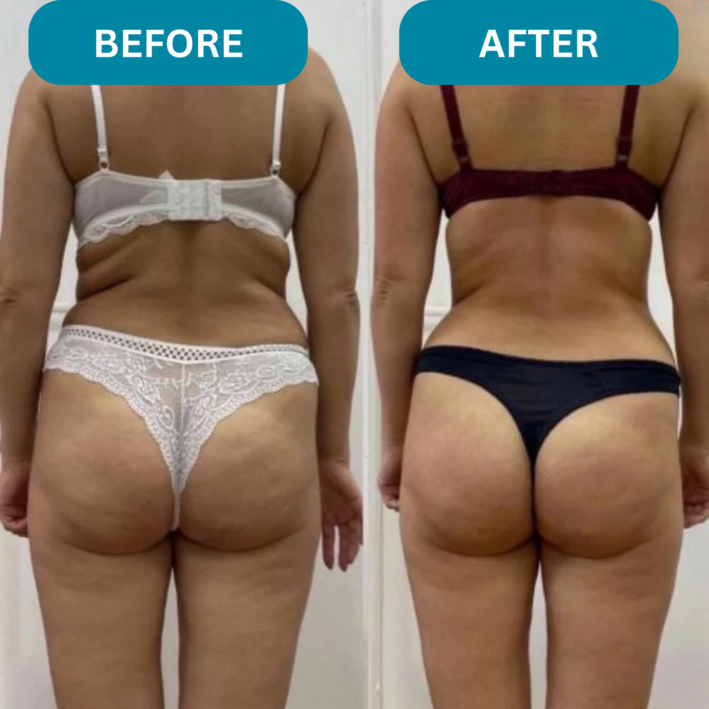 Silkiora™ Anti-Cellulite Massager